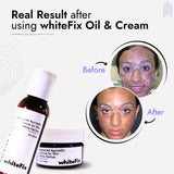 Advanced Ayurvedic Solution Kit for White Skin Patches (vitiligo)- Oil + Herbal Cream