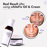 Advanced Ayurvedic Solution Kit for White Skin Patches (vitiligo)- Oil + Herbal Cream