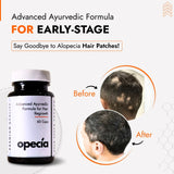 Alopecia Hair Patch Solution | Alopecia Areata Treatment Medicine | 100% Pure Extract with No Side Effects