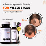 Alopecia Areata Treatment Medicine Kit – Best Natural Solution for Hair Patch, Hair Regrowth & Scalp Nourishment