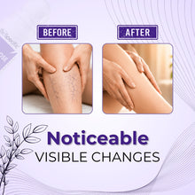 Ayurvedic Oil for Varicose Vein | 100% Natural & Safe