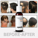 Alopecia Hair Patch Oil with Roller  - Advanced Formula for Alopecia Areata Treatment