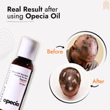 Alopecia Oil Hair Patch Solution for Bald Patches - 100% Natural Treatment