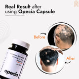 Alopecia Hair Patch Solution | Alopecia Areata Treatment Medicine | 100% Pure Extract with No Side Effects
