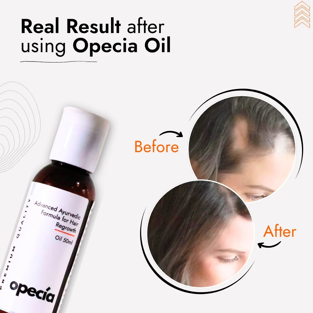 Alopecia Oil Hair Patch Solution for Bald Patches - 100% Natural Treatment