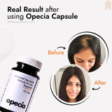Alopecia Hair Patch Solution | Alopecia Areata Treatment Medicine | 100% Pure Extract with No Side Effects