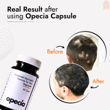 Alopecia Hair Patch Solution | Alopecia Areata Treatment Medicine | 100% Pure Extract with No Side Effects