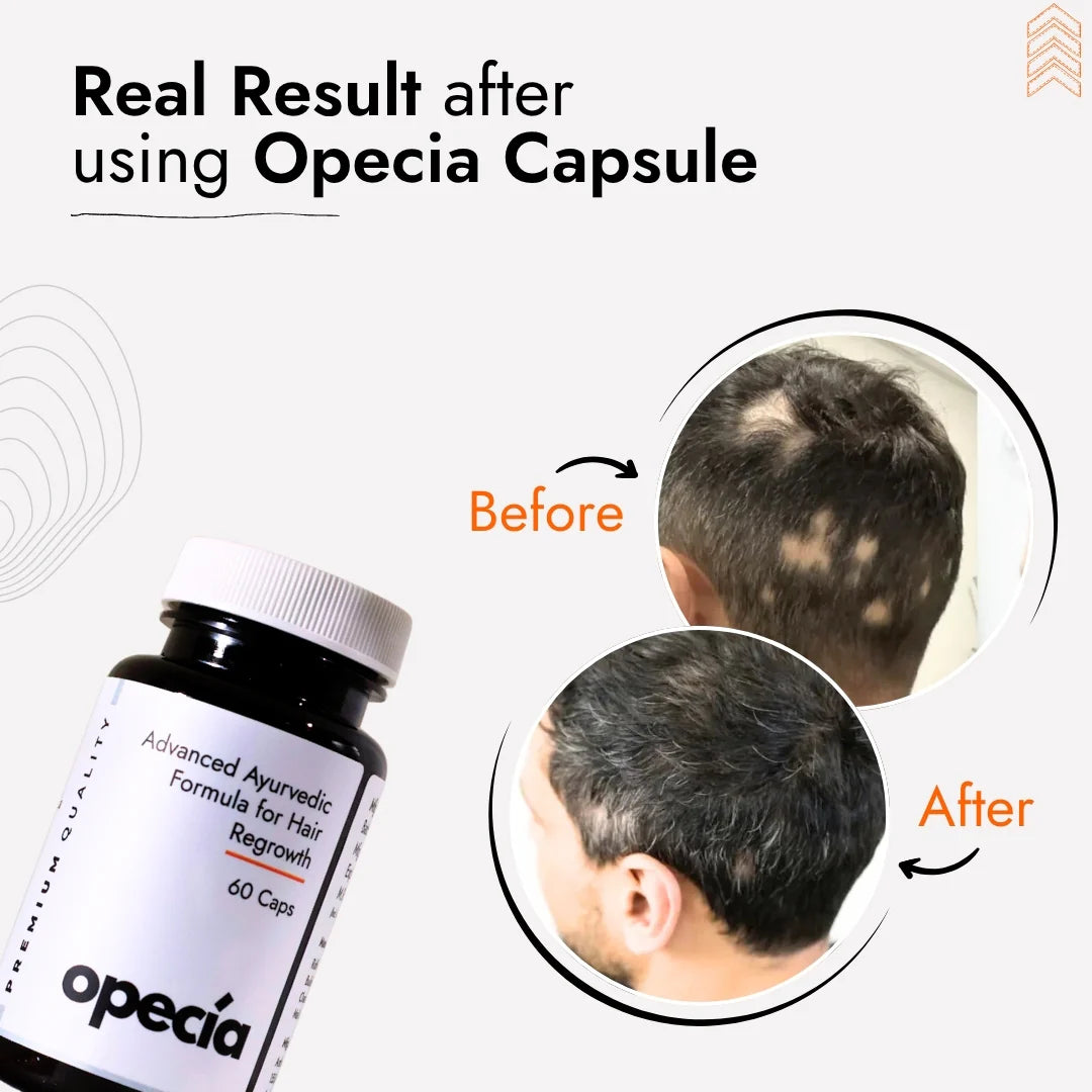 Alopecia Hair Patch Solution | Alopecia Areata Treatment Medicine | 100% Pure Extract with No Side Effects
