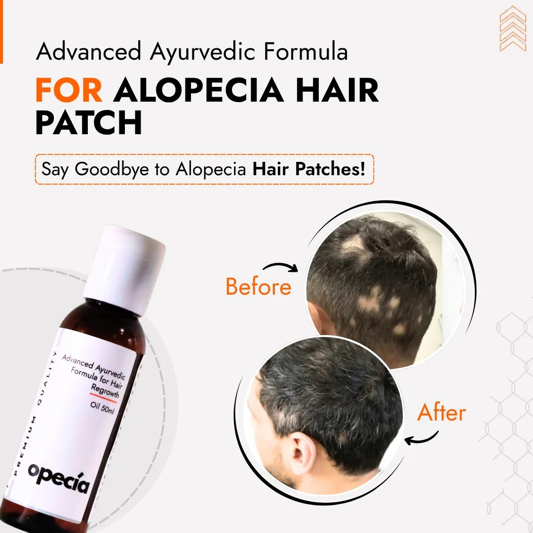 Alopecia Oil Hair Patch Solution for Bald Patches - 100% Natural Treatment