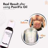 Ayurvedic Natural Oil for Psoriasis & itching (for Day Use)