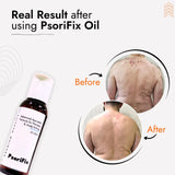 Ayurvedic Natural Oil for Psoriasis & itching (for Day Use)