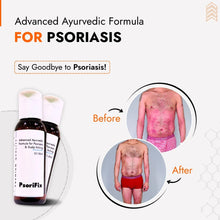 Advanced Ayurvedic Formula for (Scalp) Psoriasis & Eczema Care