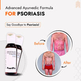 Ayurvedic Natural Oil for Psoriasis & itching (for Day Use)