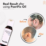 Ayurvedic Natural Oil for Psoriasis & itching (for Day Use)