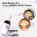 Advanced Ayurvedic Solution Kit for White Skin Patches (vitiligo)- Oil + Herbal Cream