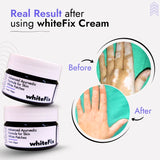 Ayurvedic Herbal Cream for Skin White Patches (Vitiligo) - for Night Use