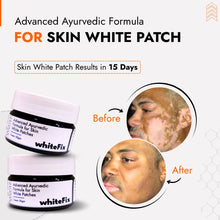Ayurvedic Herbal Cream for Skin White Patches (Vitiligo) - for Night Use