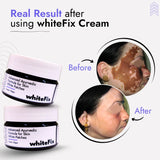 Ayurvedic Herbal Cream for Skin White Patches (Vitiligo) - for Night Use