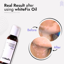 Ayurvedic Natural Oil for Skin White Patches (Vitiligo) - for Day Use