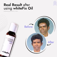 Ayurvedic Natural Oil for Skin White Patches (Vitiligo) - for Day Use