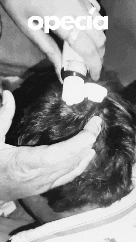 Opecia hair treatment result