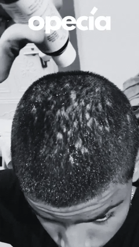 Opecia hair treatment result