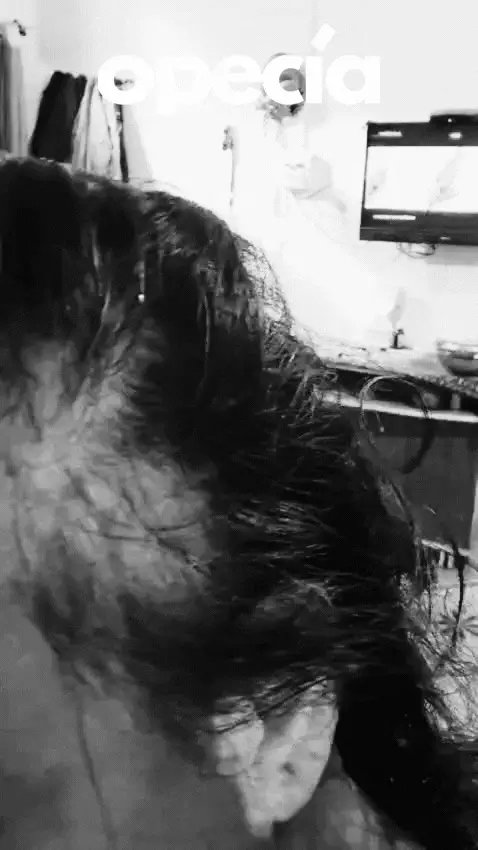 Opecia hair treatment result